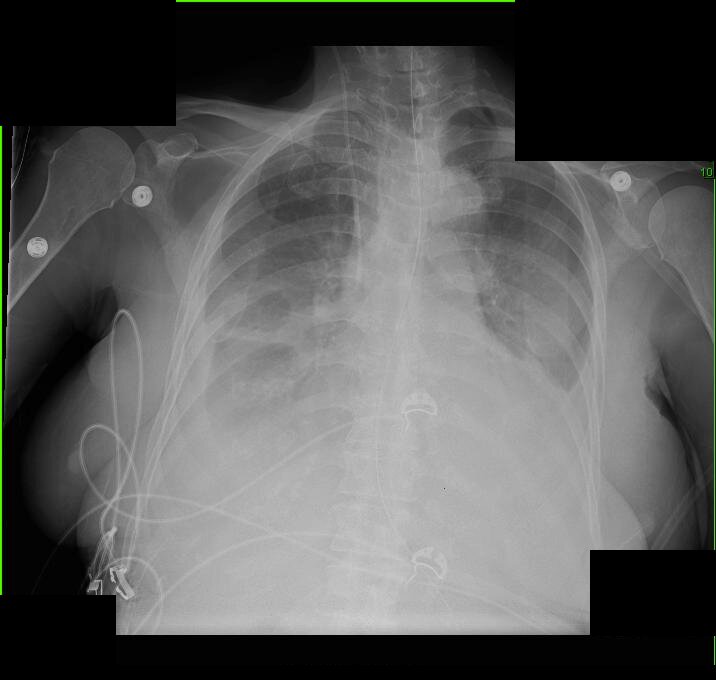 Frontal chest radiograph taken after fluid resuscitation, with monitoring leads and lines; identifying text blacked out